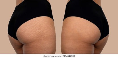 Stretch Mark Repair and Camouflage Consultation