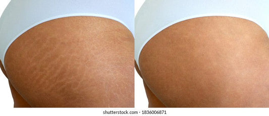 Stretch Mark Repair and Camouflage Consultation